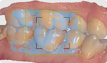 Фото Интраоральный 3D Сканер 3Shape TRIOS 3 Basic Pod